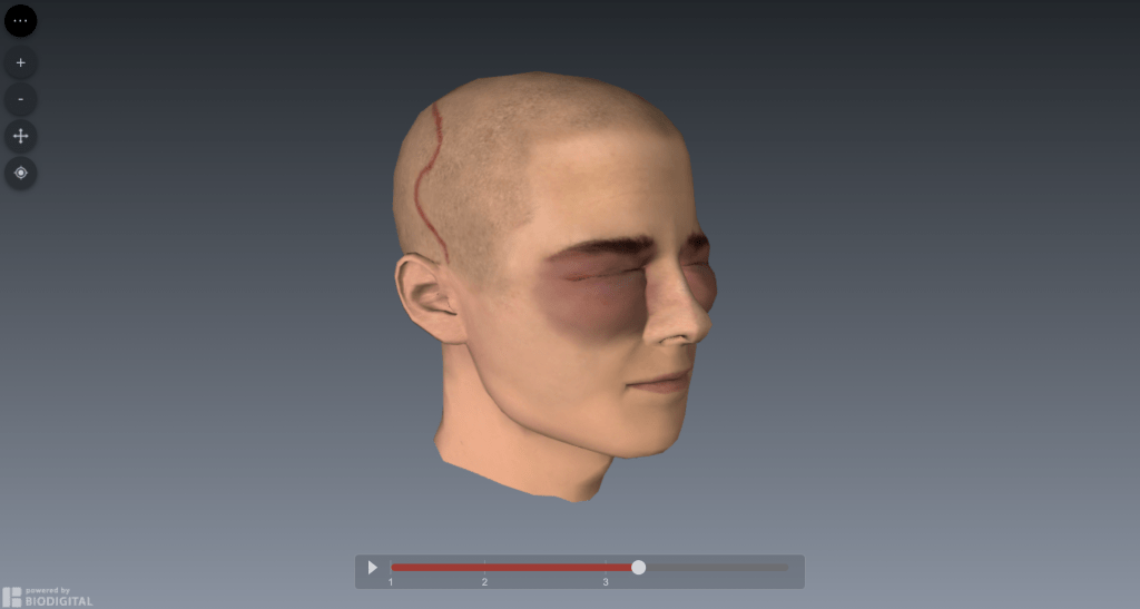 Le Fort III Surgery – myFace