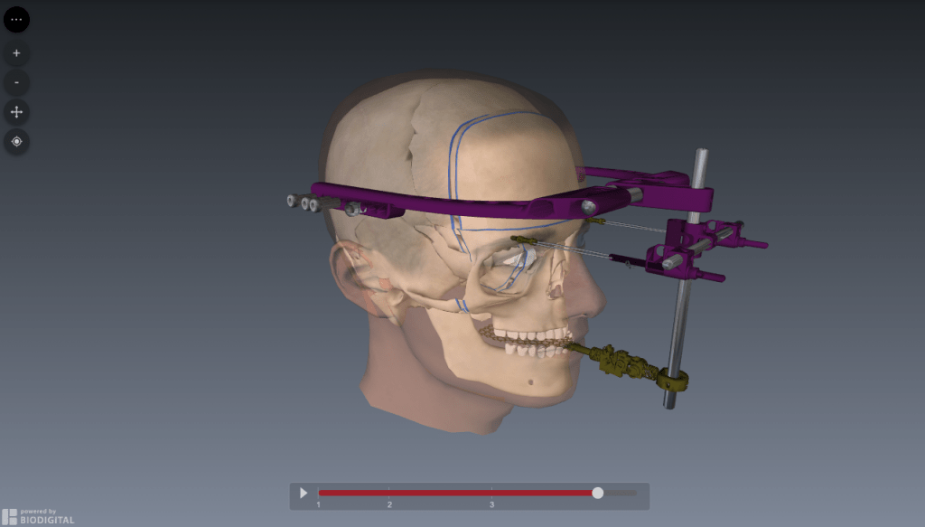 Monobloc Procedure myFace