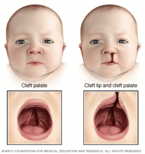 Cleft Lip and Palate